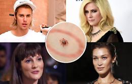 Cos'è la malattia di Lyme, la patologia trasmessa dalle zecche che tormenta le star