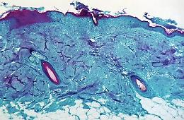 Vaiolo delle scimmie, negativi tutti e due i casi sospetti in Sicilia